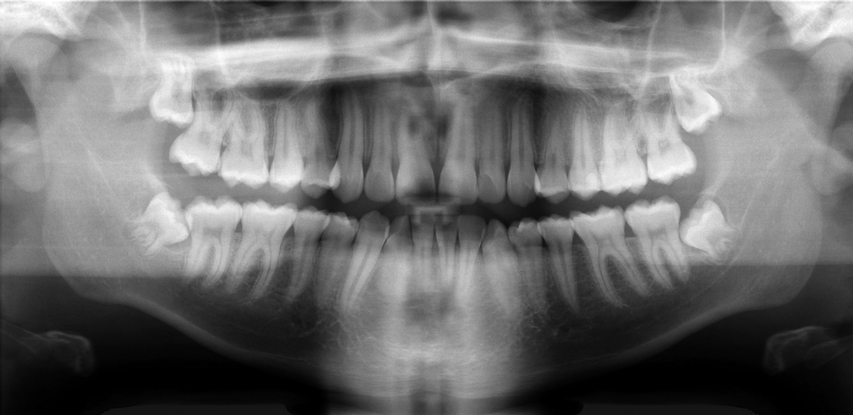 Panoramic Dental X-ray image-Lorne Park Dental Associates-Mississauga-Lakeshore Dentist