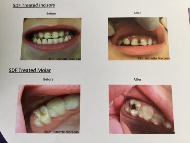 SDF before & after treatment - Dr. Jeanette MacLean