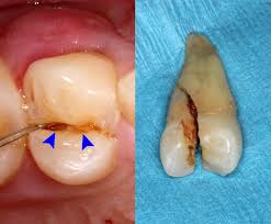 cracked tooth-Lakeshore Dentist-Mississauga-Lorne Park Dental
