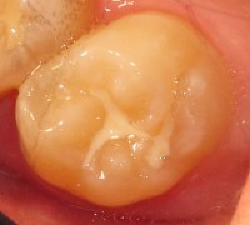 Dental tooth sealant, Mississauga Dentist