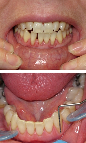 teeth-recession-blog Mississsauga Dentist