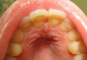 tooth erosion caused by bulimia-Lorne Park Dental Associates