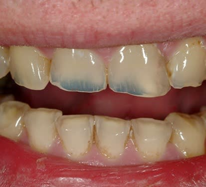 dental erosion on anterior teeth-Lorne Park Dental Associates