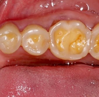 dental erosion on molars-Lorne Park Dental Associates