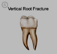 vertical tooth root fracture-Lakeshore Dentist-Mississauga